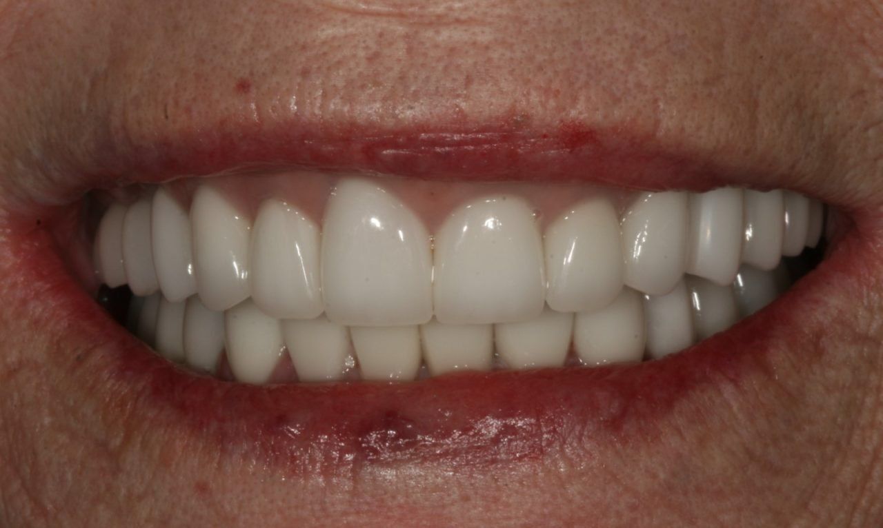 Before Full Mouth Rehabilitation Female Patient — Rogers, AR — Ozark Comprehensive Dentistry