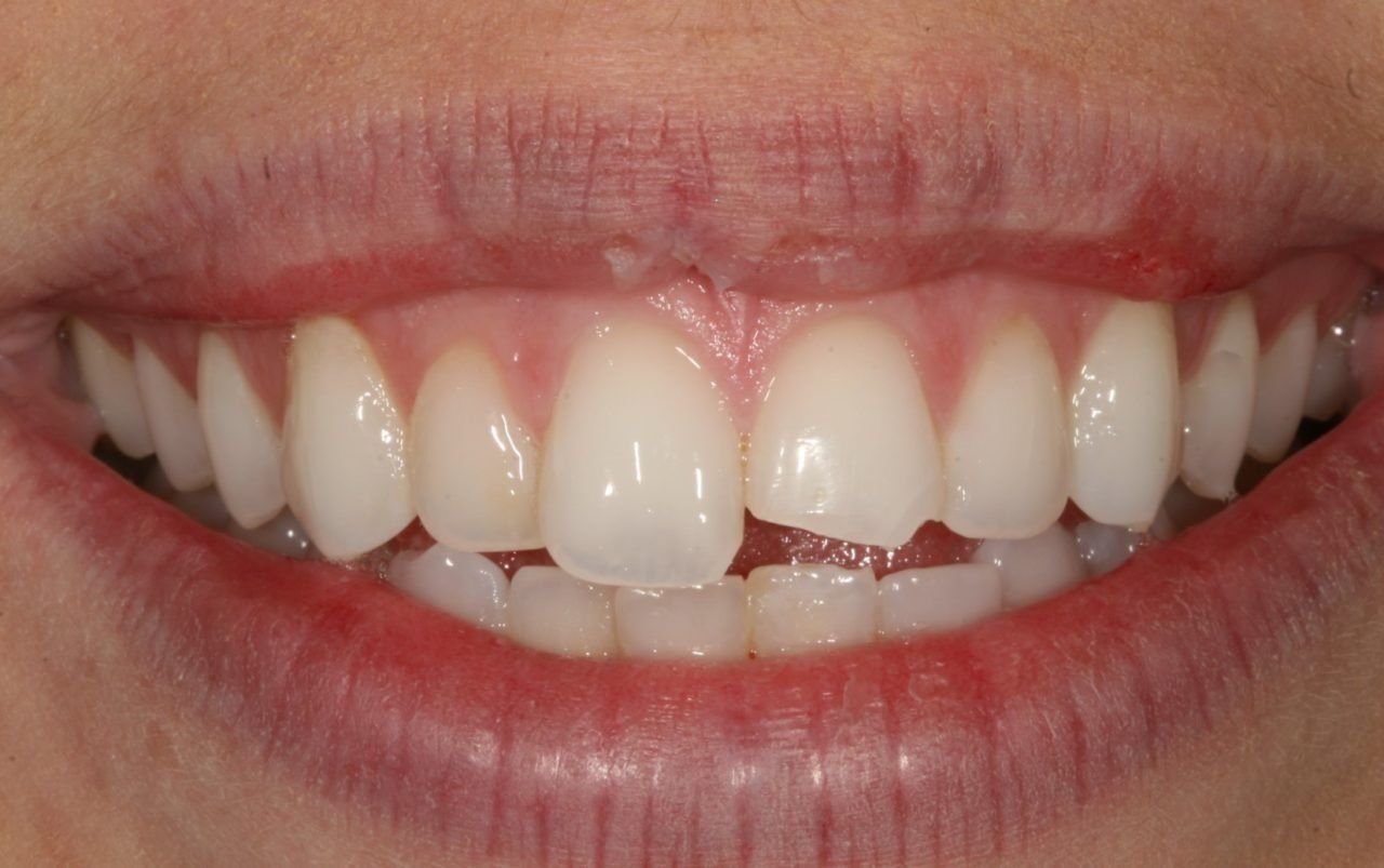 Before Porcelain Veneers Actual Patient — Rogers, AR — Ozark Comprehensive Dentistry