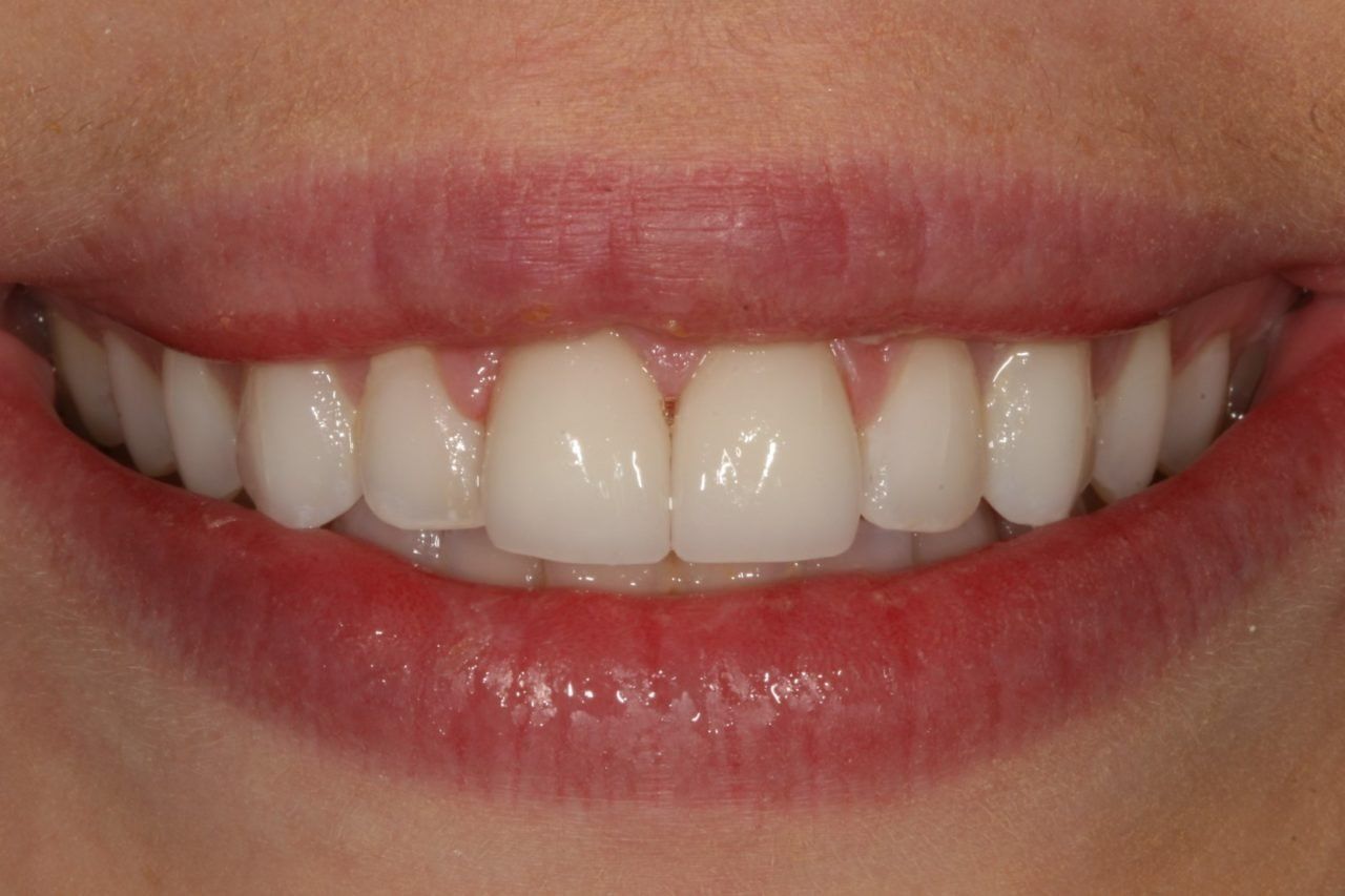 After Porcelain Veneers Actual Patient — Rogers, AR — Ozark Comprehensive Dentistry