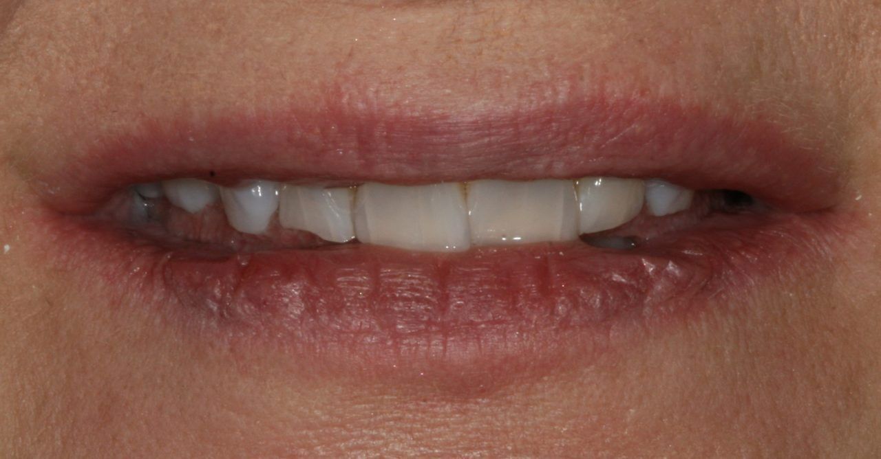 Before Cosmetic Dentistry Actual Patient — Rogers, AR — Ozark Comprehensive Dentistry