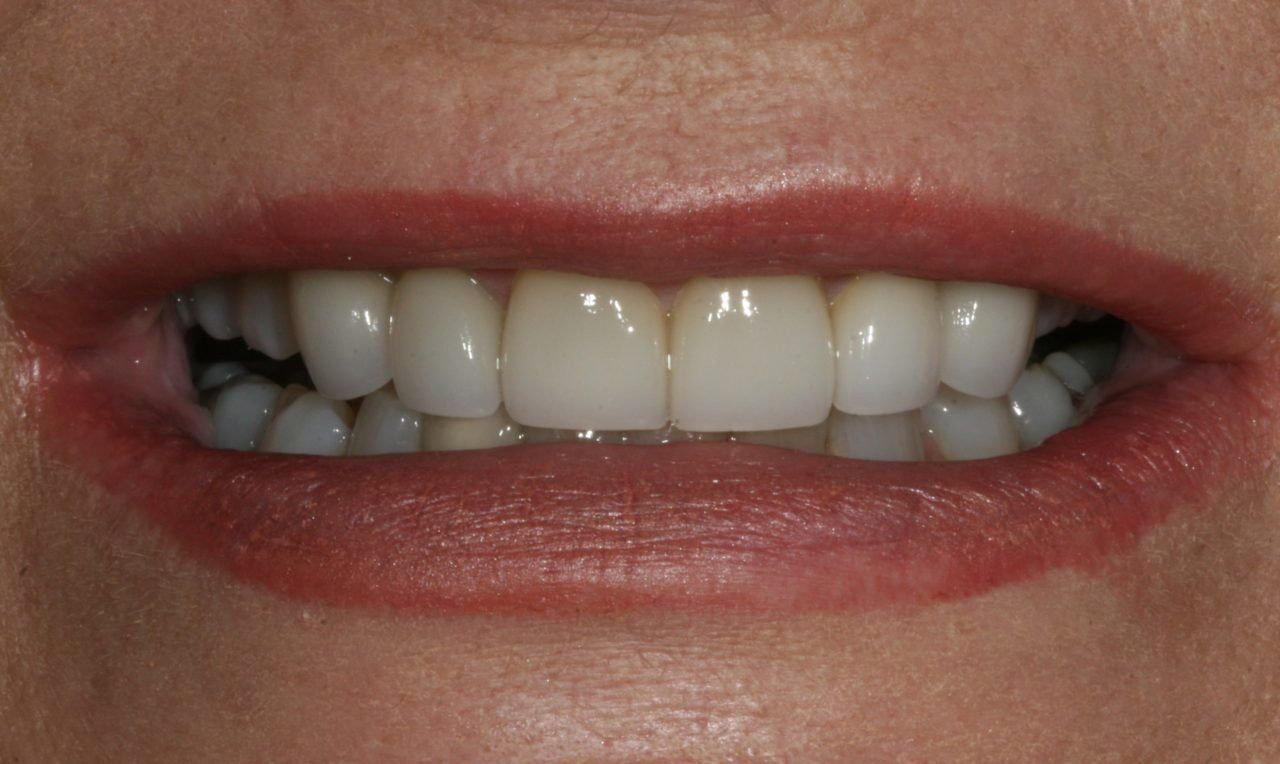 After Cosmetic Dentistry Actual Patient — Rogers, AR — Ozark Comprehensive Dentistry