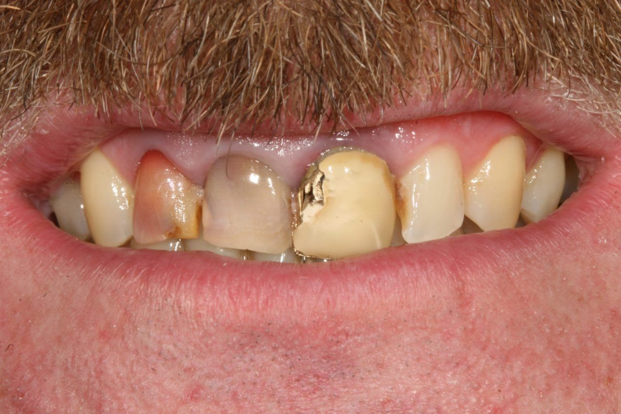 3 Front Teeth Before Treatment — Rogers, AR — Ozark Comprehensive Dentistry