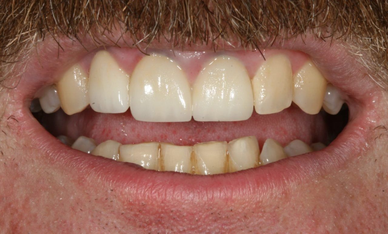 3 Front Teeth After Treatment — Rogers, AR — Ozark Comprehensive Dentistry