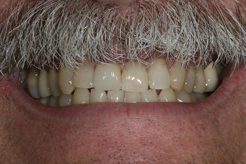 Replaced Front Bridge Actual Patient — Rogers, AR — Ozark Comprehensive Dentistry