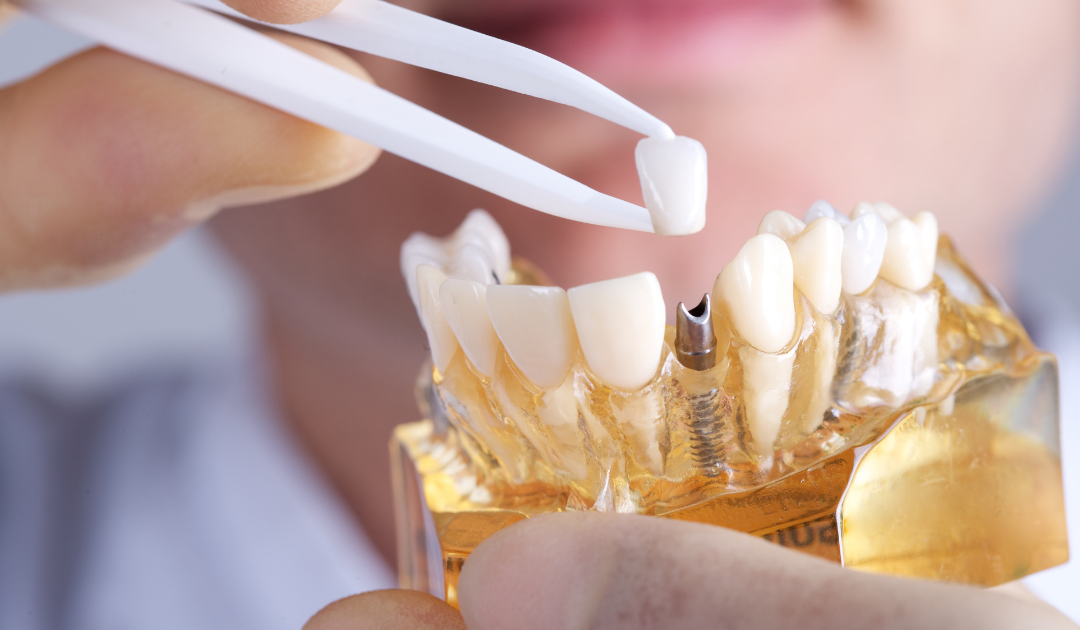 Dental Implant Clinic — Rogers, AR — Ozark Comprehensive Dentistry