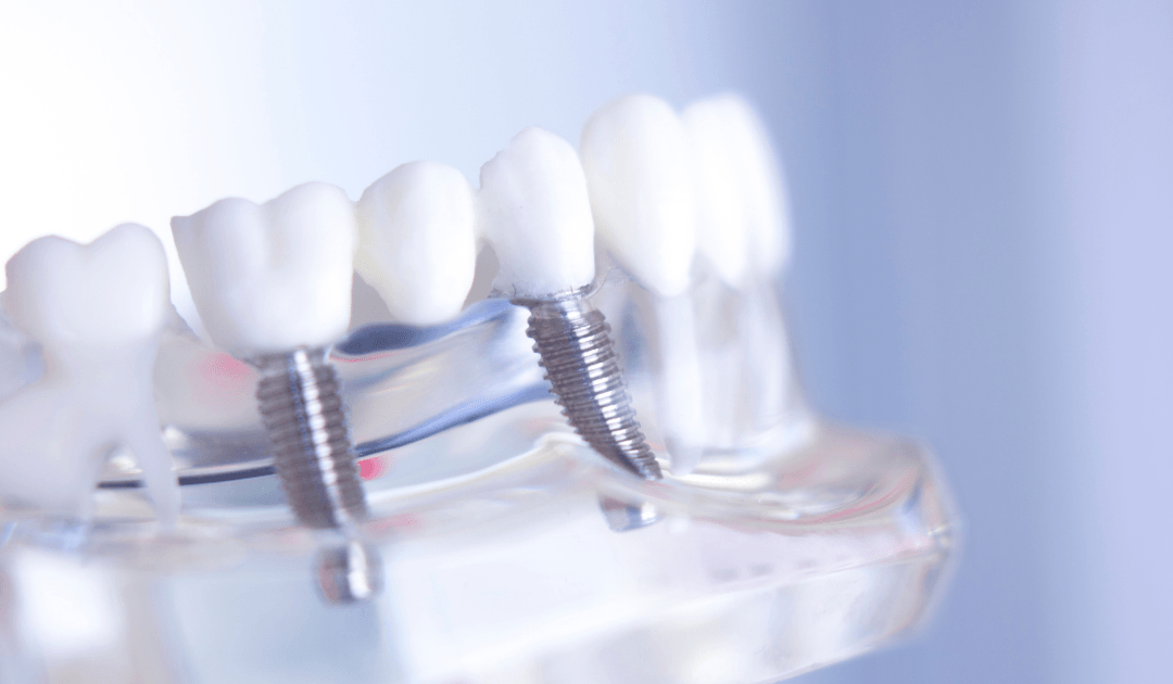Dental Implants Procedure — Rogers, AR — Ozark Comprehensive Dentistry