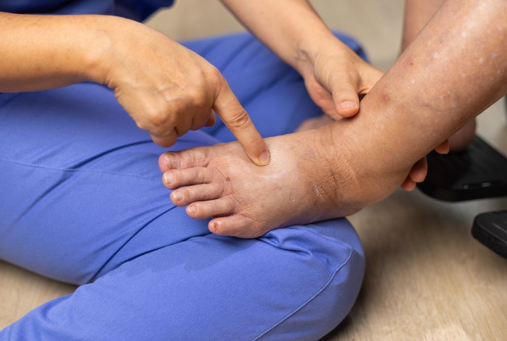 Swollen foot being examined by a person in blue scrubs, indoors.