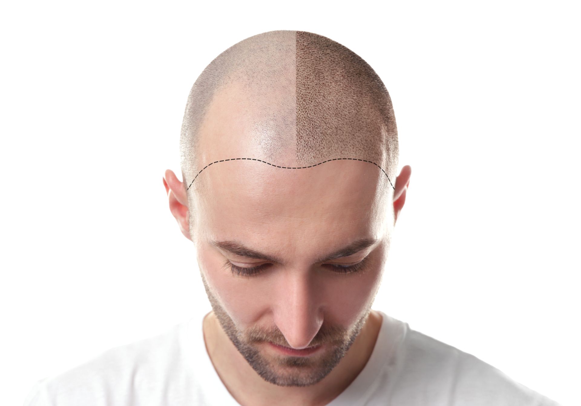 a man with a shaved head has a line drawn on it .