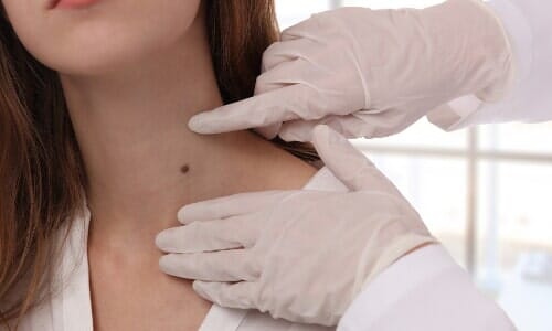Doctor Examines Mole of a Woman — Dermatology in New York, NY