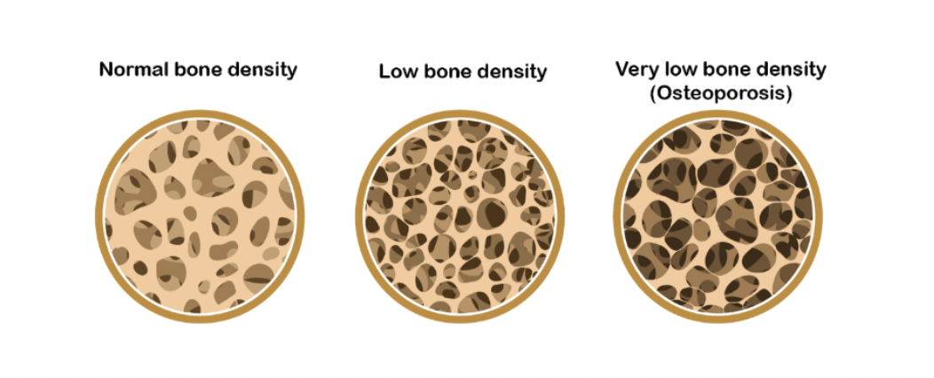 bone density differences