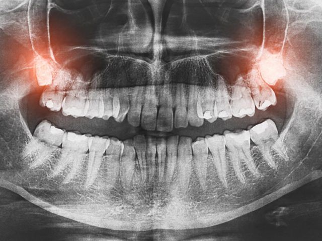X-ray of teeth and Wisdom teath