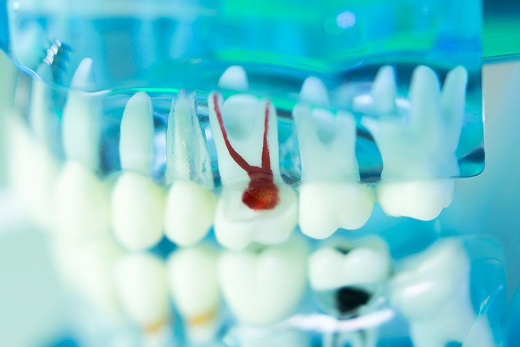 Model of teeth with root canal procedure highlighted in red.