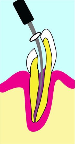 Image of root canal therapy 2