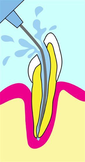 Image of root canal therapy 3