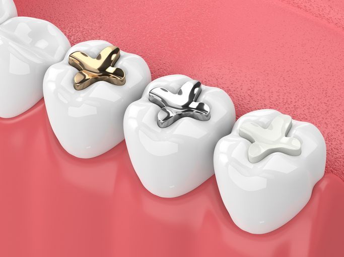 Teeth with dental fillings of gold, silver, and white composite materials.
