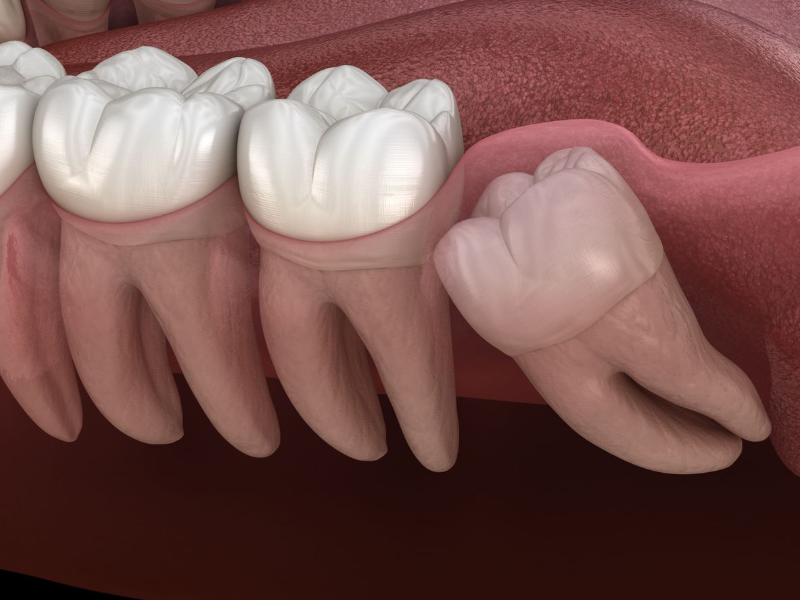 A 3D rendering showing an impacted wisdom tooth pushing against adjacent molar.