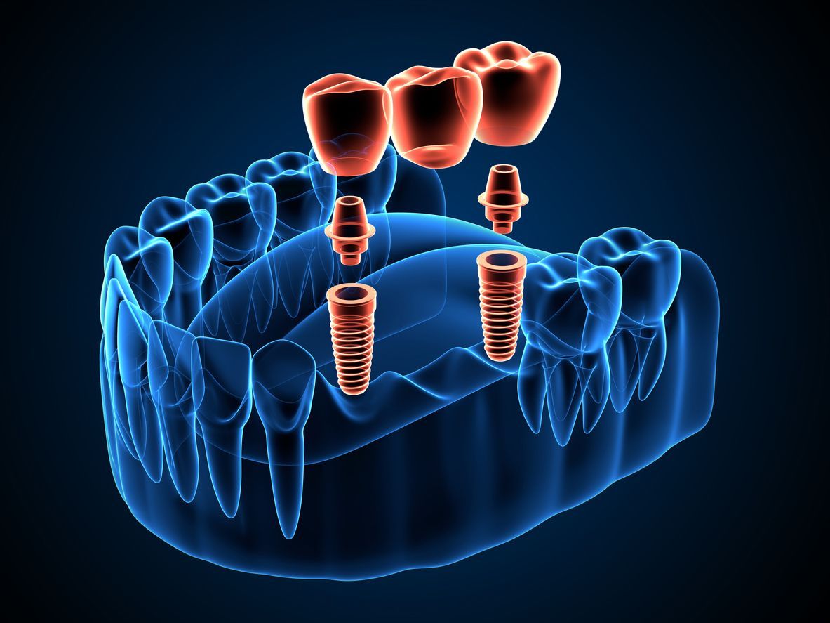 Anatomical rendering of a jaw with dental implants supporting a bridge of three crowns.