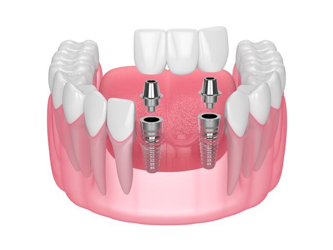 Dental implant illustration: jaw model with implanted posts, abutments, and a bridge.