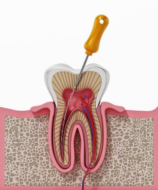 Cross-section of tooth with dental tool inside, showing root canal treatment process.