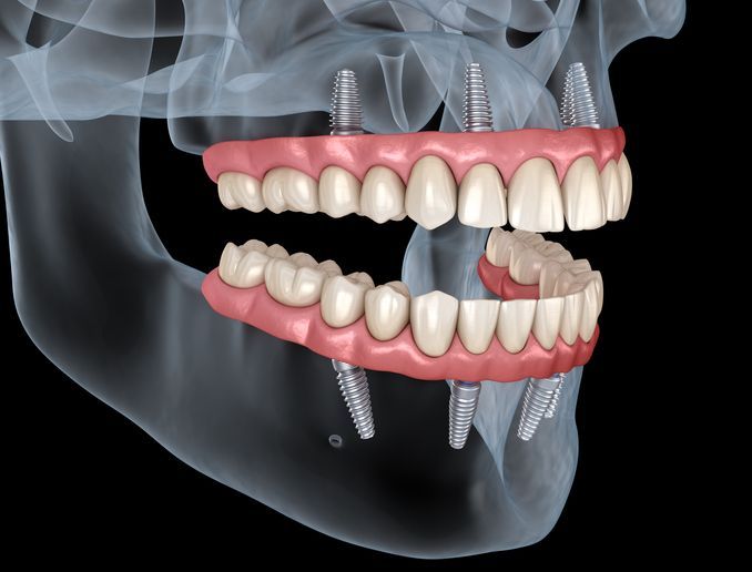 Dental implants supporting upper and lower dentures, rendering of a jaw and teeth.