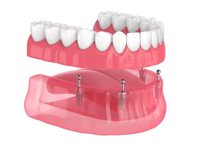 Dental implants supporting an upper and lower set of dentures; pink gums, white teeth.