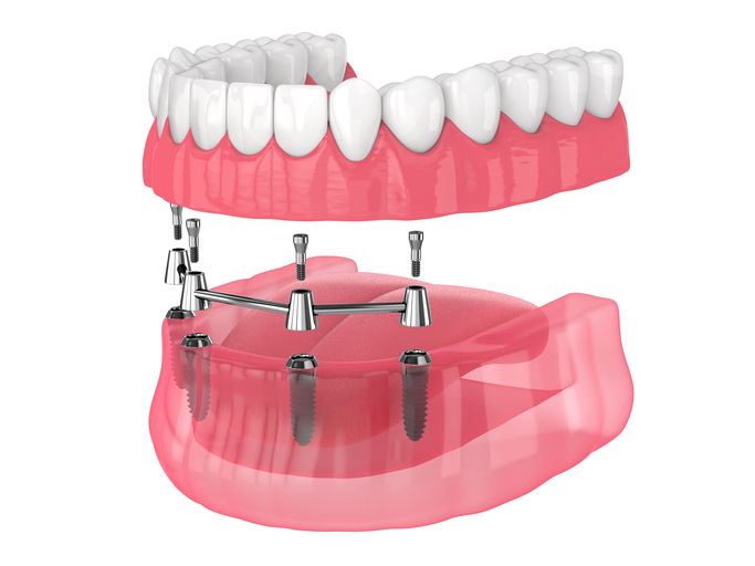 Dental implant-supported dentures. Pink gum models with white teeth and metal implants.