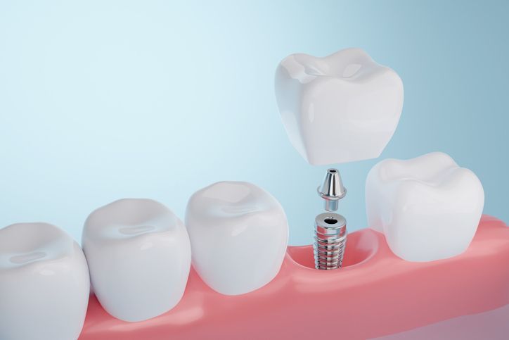 Dental implant model with a crown being placed on an artificial tooth.