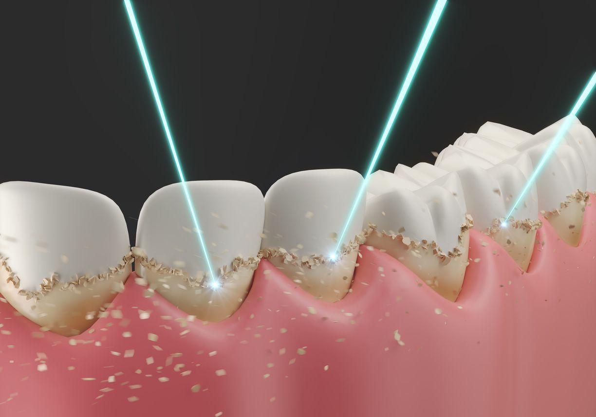 Teeth being treated with laser beams to remove debris, close-up, black background.