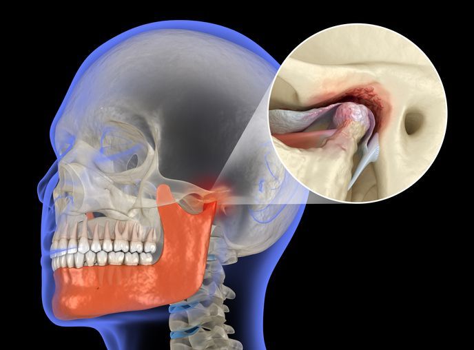 X-ray of a skull highlighting the jaw; a detailed view shows inflamed temporomandibular joint, indicating possible jaw pain.