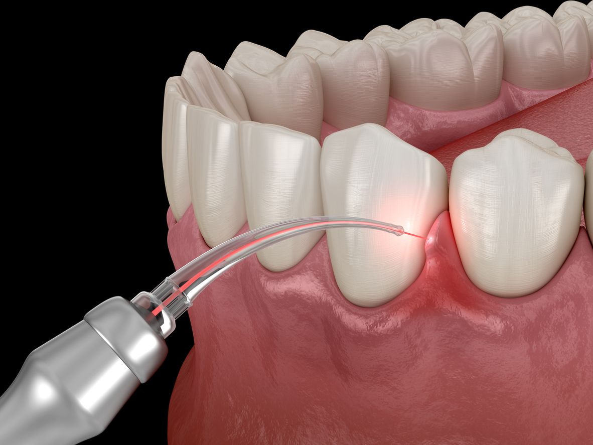 Laser dental treatment on a tooth; red gums and silver dental tool emitting red light.