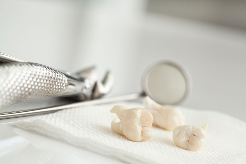 Extracted teeth on a gauze pad with dental tools, including forceps and a mirror, on a white surface.