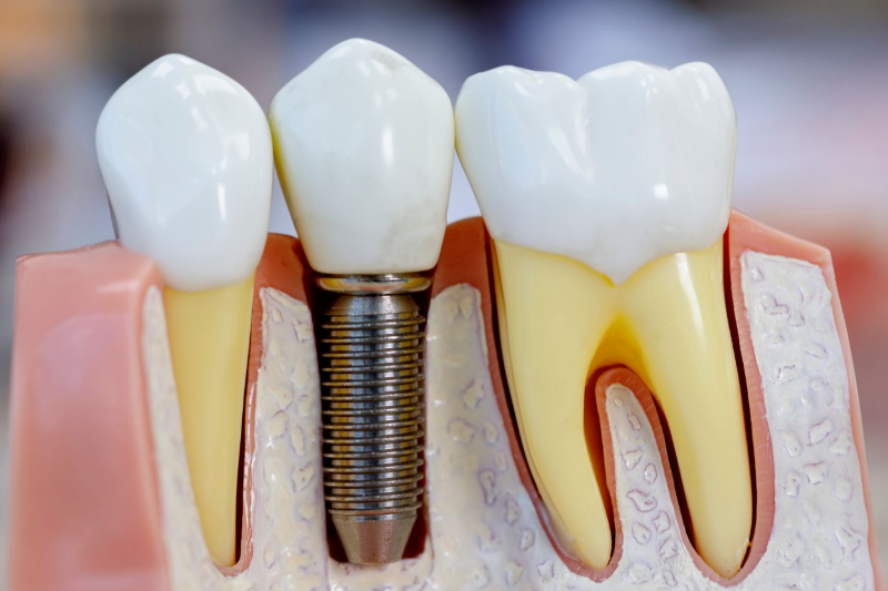 Model of three teeth, one with a dental implant, showing root structure and gum, on a pink and beige display.