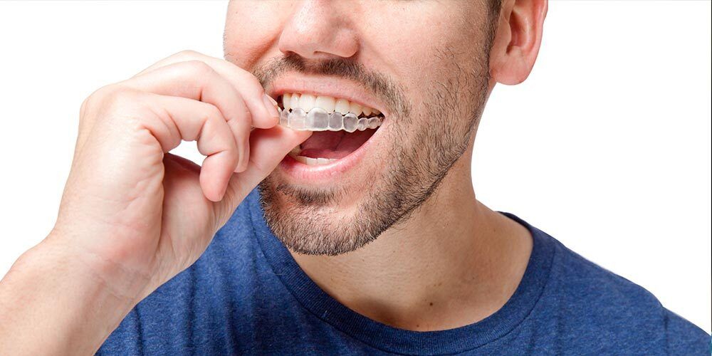 Man inserting a clear aligner into his mouth. He wears a blue shirt.