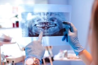 Tooth Extractions — Teeth X-ray Image in Cumming, GA