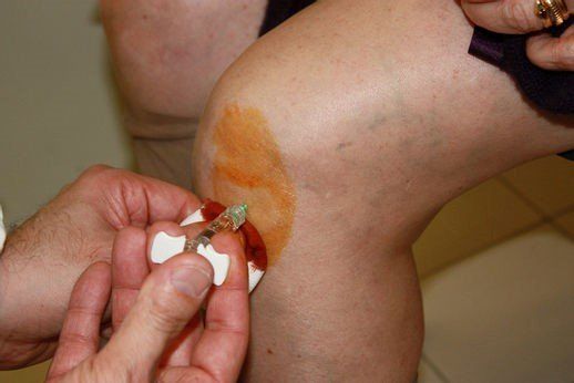 Terapia infiltrativa