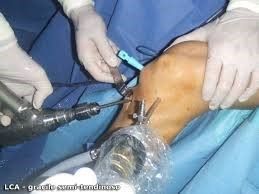 Intervento al ginocchio