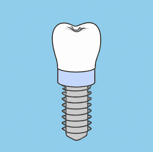 Dental Implants in Whitby