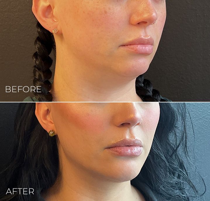 A before and after photo of a woman 's face