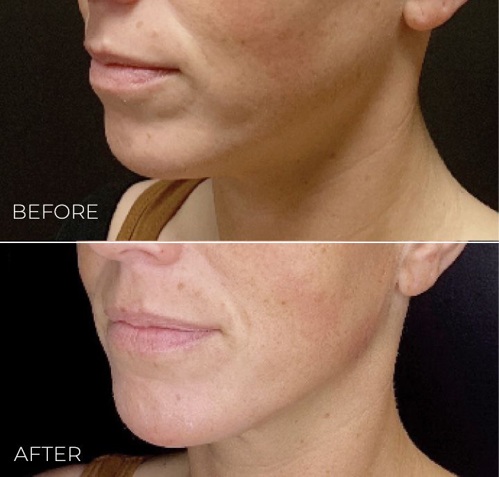 A before and after photo of a woman 's face