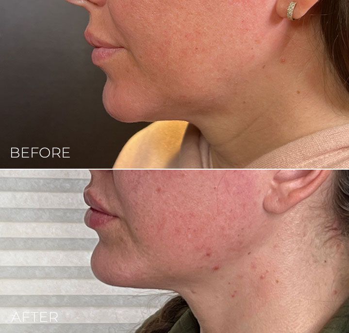 A before and after photo of a woman 's face.