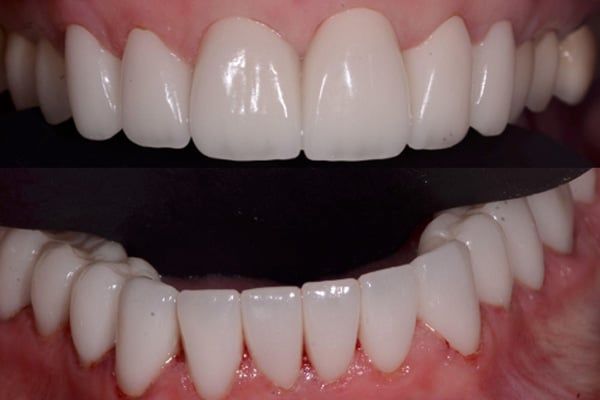 crowns, veneers, and full mouth reconstruction after