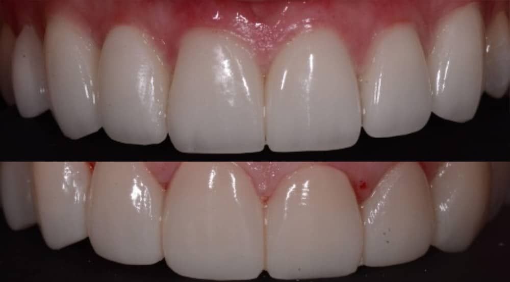 crowns, veneers, and full mouth reconstruction before & after
