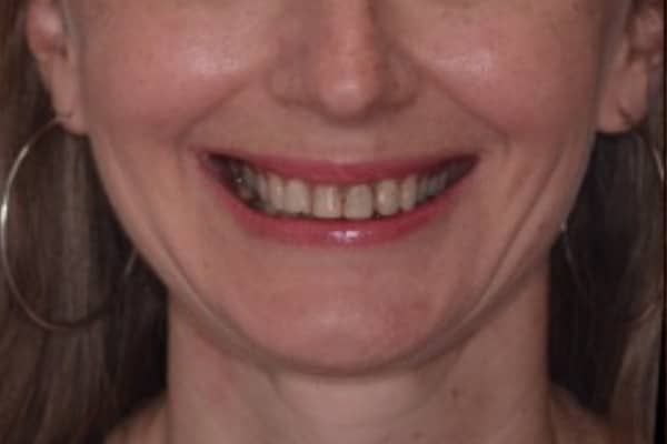 crowns, veneers, and full mouth reconstruction before