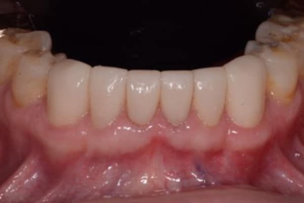 Periodontal Surgery After