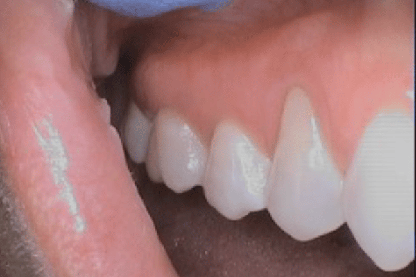 Periodontal Surgery Before