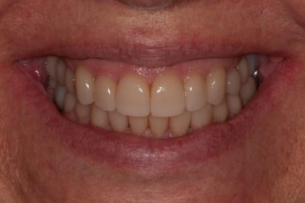 crowns, veneers, and full mouth reconstruction after