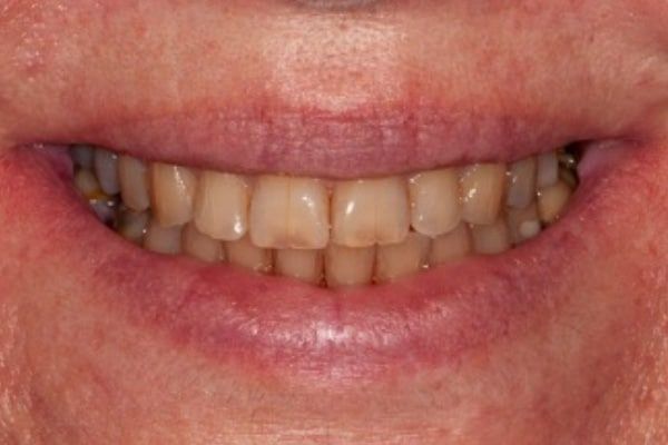 crowns, veneers, and full mouth reconstruction before