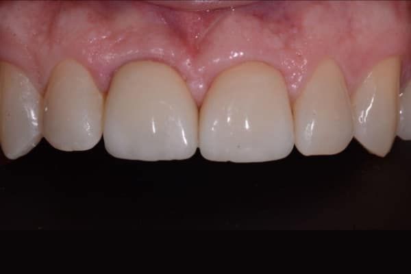 Central Incisors Implant Cases