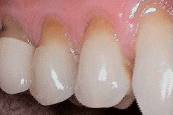 Periodontal Surgery Before