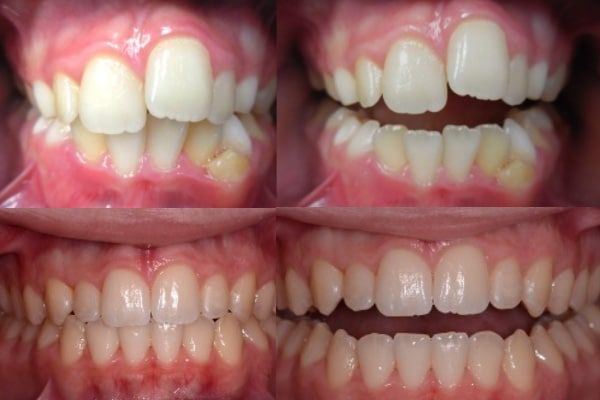 Invisalign before and after case